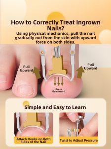 IMLUCKY | Ingrown Toenail Corrector Tool