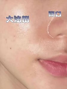 ORGINESE | Pore Refining Acne Treatment Essence