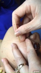 Chấm mụnnámtàn nhang lấp đầy sẹo rỗ 7 ngày bong Nám Chấm nám KHẮC TINH CỦA NÁM CHÂN ĐINH TÀN NHANG