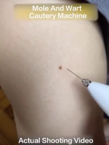 Rosemarry-Portable Laser Plasma Pen Facial Freckle Dark Warts Spot Mole Removal Machine