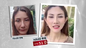 3 ขวด เซรั่มฟิลเลอร์ หน้าอิ่มฟู ดูเด็ก ปากอิ่มฟู  หน้าใส หน้าอิ่ม เกาหลี