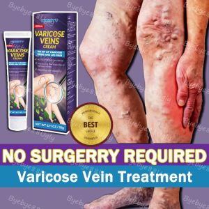 Natural Herbal Varicose Veins Treatment Cream Phlebitis Pain Relief Ointment