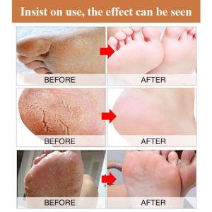 Hot foot peeling exfoliate callus remover spray pedicure dead skin remover cracked heel repair moisturizing foot care herb tumit kaki merekah去角质喷雾100ml