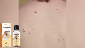 South Moon Bee Venom Skin Tag Solution Mole Removal Serum Skin Tag Effective Removal Face Wart Dark Spot 30ml