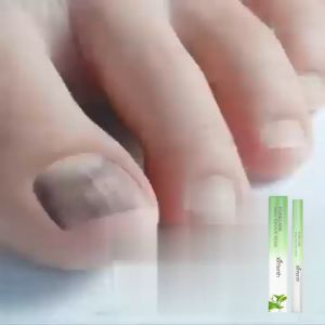 Ximonth Pena Perawatan Kuku untuk memperbaiki onikomikosis dan menebalkan kuku yang lembut