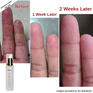 Squalane Oil Moisture Dry Skin Nappy Rash Bedsores Burns Scar Dandruff Sensitive Skin