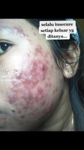 BDermabeauty Day Cream Acne