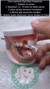 Penambal Gigi Berlubang Permanen atau Lepas Pasang Isi 200 Butir