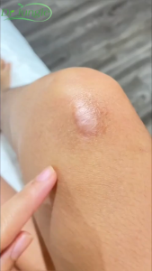 🔥ของแท้🔥Drjungle แผ่นแปะลดรอยแผลเป็น แผ่นแปะซิลิโคน ลดรอยแผลเป็นใหม่และเก่า ลดรอยแผลนูน แผลเป็น และแผลจากการตัดผ่าตัด ฟื้นฟูผิวส้ม และเส้นการเจริญเติบโตของผิวให้เรียบเนียน ขนาด 4*7.5cm