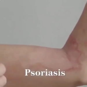 [100%effective]Cream untuk kulit gatal Psoriasis Eczema treatment cream anti fungal cream ointment krim gatal kulit ekzema ubat gatal gatal kulit Non-steroidal.湿疹牛皮癣霜
