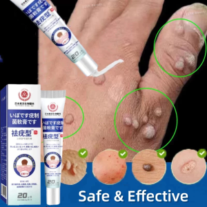 Warts removal cream 20g ubat kutil buang tahi lalat dan biji kolestrol Skin Tag Remover Mole repellent Ubat buang kutil