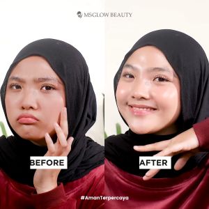 Paket Perawatan Jerawat MS GLOW - ACNE PACKAGE GRATIS HADIAH