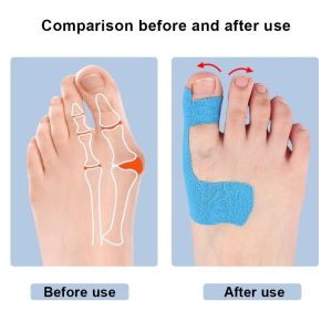 10PCS Precut Bunion Corrector Tape - Big Toe Support for Hallux Valgus Breathable Hypoallergenic Kinesiology Tape for Men Women