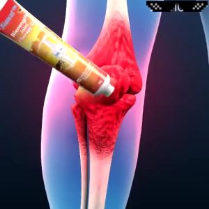 【BUY 1 TAKE 1】Bee Venom Treatment Gel Joint Relief Gel Bees Venom Massage Gel Joint and Bone Treatment Pain Relief for Propolis Gel gout ointment cream meniscus pain relief ointment 20g