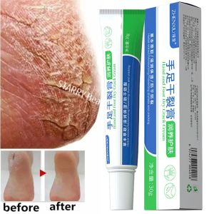 SADOER | Foot Fungus Removal Cream Relieve Foot Itching Remove Beriberi Dead Skin Foot Sweat Moisturize Repair Foot Cracked Ointment