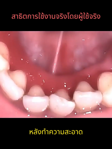 Langton เครื่องขูดหินปูน 31000ครั้ง/นาที เครื่องทำความสะอาดฟันไฟฟ้าระบบอัลตราโซนิก เครื่องขูดหินปูนไฟฟ้า ที่ขูดหิน