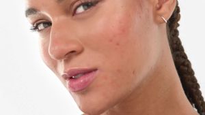 Eucerin Pro Acne Solution SOS Serum 40ml | Oily & Acne Prone Skin | Derma