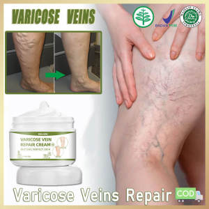 vericose vein cream 静脉曲张 krim panas sakit urat jamu sakit urat varicose veins medicine 30g Effective treatment of varicose veins Blood circulation and relief of pain Treatment of blood vessels