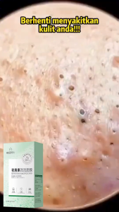 100% Effective Blackhead Removal Anthocyanin Bubble Mask: Whitening Hydrating Moisturizing Pore Minimizing Deep Cleansing Acne Treatment Brightening Exfoliating and Whitening Mask