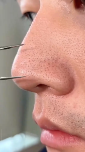 Special bubble mask for cleansing pores avocado complex acid mask acne-fighting and moisturizing mask bubble whitening mask deeply cleanses and tightens pores letting your skin breathe!