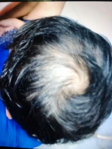 ยาปลูกผม อโลทิส Alotis 3กล่อง ของแท้ 100% มี อย.ทุกกล่อง ราคาโรงงาน หมดอายุ 25/08/2027 แถมเซรั่ม 10มล. 3ขวด