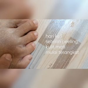 Peeling TCA 5% Free Kuas: Perawatan Kulit Wajah yang Aman