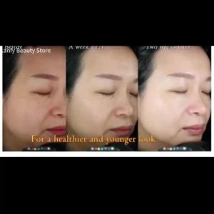Whitening Freckles Face Cream Removal Melasma Dark Spots Corrector Lighten Melanin Pigmentation Brighten Anti-Aging Beauty Care