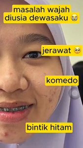 Sabun Penghilang Bekas Jerawat