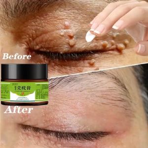 Skin Tags Mole Remover Warts Remover Cream Corn Removal 20g Antibacterial Foot Warts Hand Warts Corn Skin Tag Warts Remover