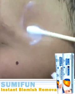 Eelhoe Wart Removal Ointment 20g Hand and Foot Face Armpit Meat Neck Filigreous Pinnacles Unusual Sharp Ointment