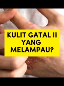 KRIM BIDARA GELENGGANG RUQYAH UNTUK ECZEMA & KEGATALAN IQTIYAR