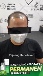 Promo besar! Myiwe Hair Growth Serum Penumbuh Rambut Botak dan Cegah Rontok