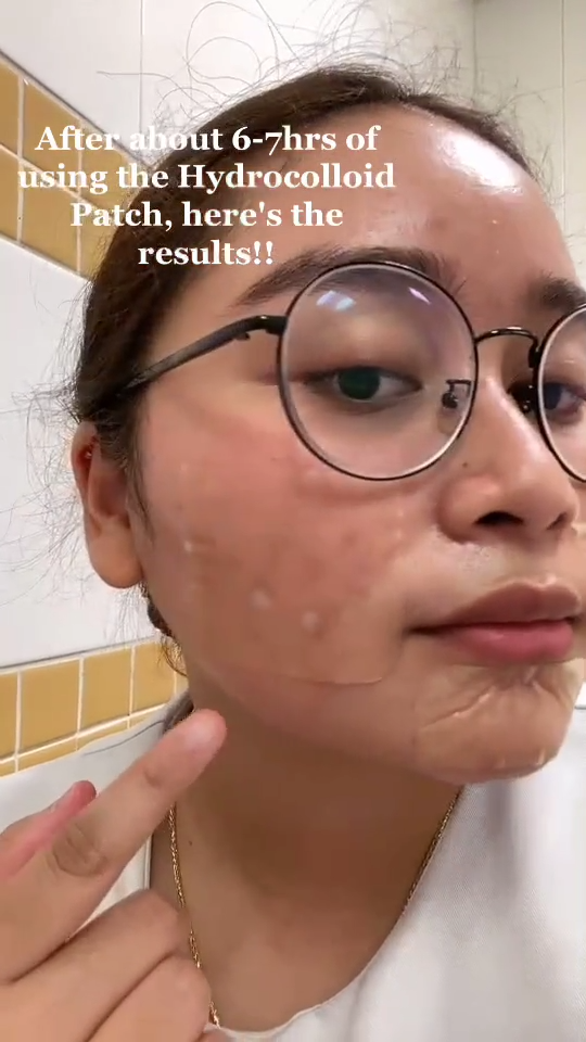 Medical Grade Hydrocolloid Sheet Roll of Tapes Hydrocolloid Patch Bandages For Scar Acne | All Skin