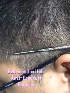 Selenium Disulfide Anti-Dandruff Shampoo Psoriasis Shampoo For Itchy Scalp Hair Treatment 150ml