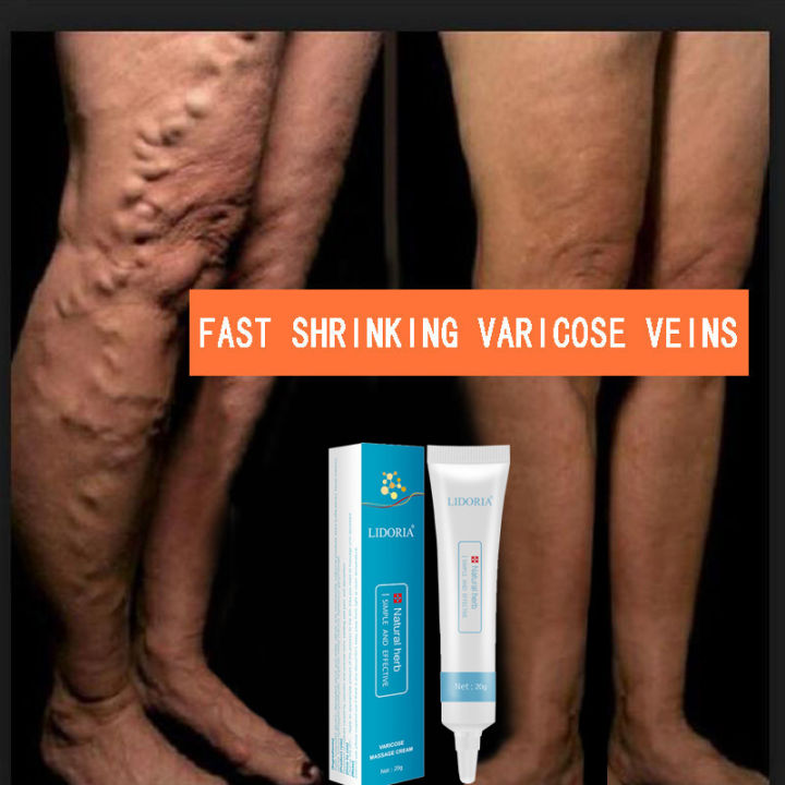 Varicose Veins Treatment Cream 20g Effective Vasculitis Phlebitis