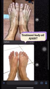 D’SAVIOR Body Oil 30ml | Penghilang Bekas Luka Eksim Psioriasis Stretchmark dan Gatal Alergi