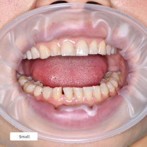 5PCS 3D O-Shape Dental Lip Cheek Retractor Latex-Free Large/Medium/Small Flexible for Orthodontic Restoration Dentistry