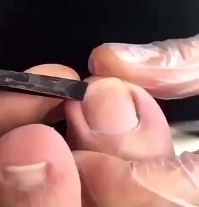 Bộ dao lấy khóe chân dụng cụ lấy khóe da nail