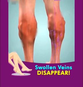 Varicose Vein Cream 30g Repair and relax Leg Cream removal varicose veins treatment Anti Foot Leg Vasculitis Swelling Earthworm Effective in relieving pain and treating phlebitis