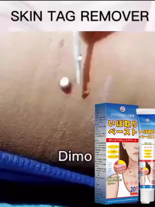 wart removal cream skin tag removal ubat hilangkan kutil 20g Natural Herbs Mole Remover 除疣膏 Genital Wart