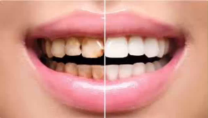 [SET 2 CHAI] Kem Đánh Răng Loại Bỏ Mảng Bám Ố Vàng Do Thuốc Lá Giúp Răng Trắng Sáng Bảo Vệ Sức Khỏe Răng Miệng Dành Cho Mọi NGười