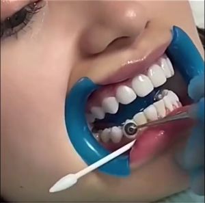 optrasculpt dental foam pad handle tool dental composite restorative material light-cured resin handle