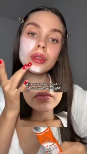 Skinoren Azelaic Acid 20% Cream 30g - For Melasma Hyperpigmentation & Dark Spots Fades Marks