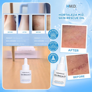 Hortaleza M.D. Skin Rescue Oil – Cacay Retinol Face Oil for Dark Spots | Redness & Sensitive Skin | Fast-absorbing formula with Vitamin E & Squalene helps repair dry skin | Acne marks & uneven tone for healthy glowing skin | Improve skin texture