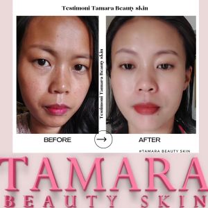 Paket Whitening Tamara Beauty: Solusi Perawatan Kulit Berjerawat