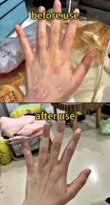 ZuDaiFu 祖大夫 Eczema Treatment Skin Fungus Cream 抑菌止痒乳膏 Herbal Cream Kulit Gatal Anti-Itching