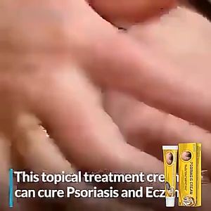 Eczema cream psoriasis treatment cream ubat gatal gatal kulit Quickly sterilize and relieve itching External use on the skin Anti-itch ointment Anti-itch antibacterial cream Relieve itching of inner thigh 20g