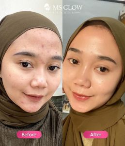 Paket Acne Series MS Glow: Mencegah Timbul Jerawat & Memudarkan Bekas