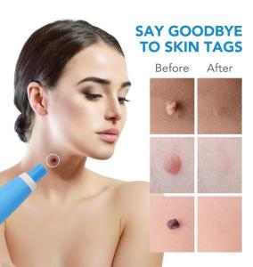 Tag Remover - Auto Skin Tag Remover Pen with 48 Micro and Regular Skin Tag Bands User-Friendly Safe and Painless Remove Small to Regular (2mm-8mm) Sized Skin Tags Mole Remover Pen