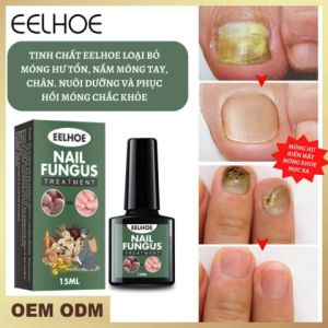 Tinh chất loại bỏ nấm móng EELHOE phục hồi móng chắc khỏe kháng khuẩn quyết vấn đề viêm móng ức chế vi khuẩn chống nhiễm nấm phục hồi móng bị hư tổn chăm sóc nấm móng hôi chân lang ben tay chân mụn cóc mụn mắt cá